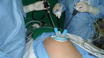 Laparoscopic ectopic surgery at Chandak hospital