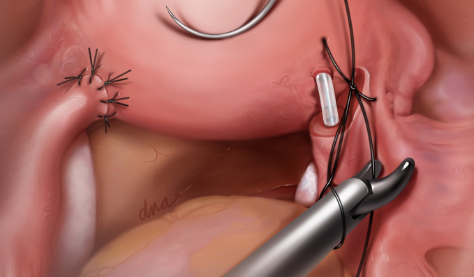 Laparoscopic tuboplasty