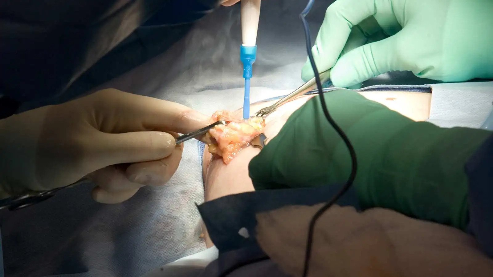 Breast Cancer surgery