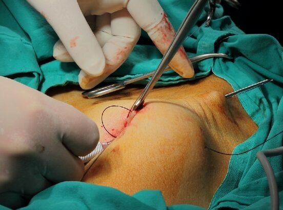 Laparoscopic tubal ligation