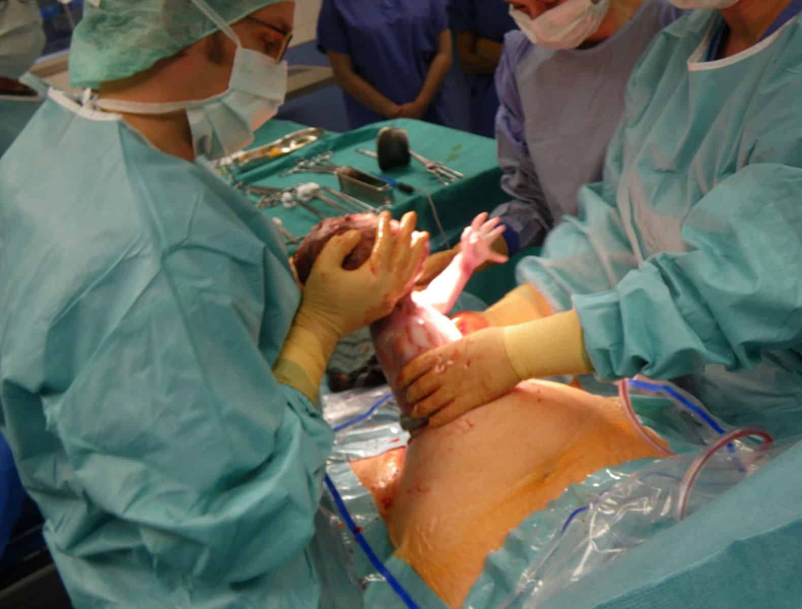 Caesarean Delivery