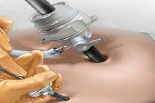 Laparoscopic Appendectomy