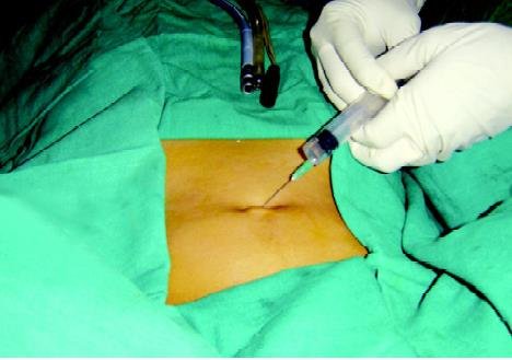 Diagnostic Laparoscopy at Chandak Hospital