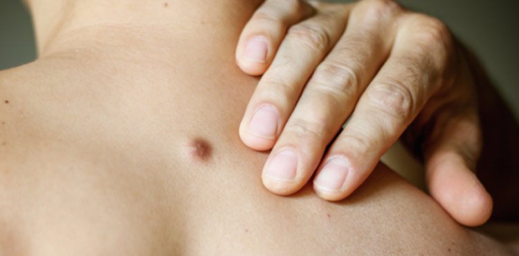 Removal of cutaneous swellings like cysts and lipomas